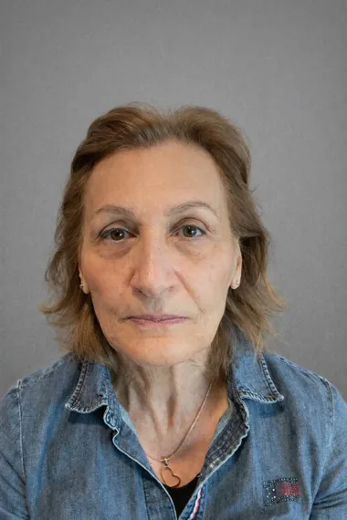 Frown lines after Botox