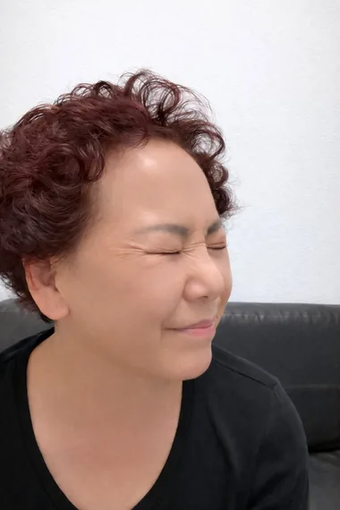 Crow's feet after Botox