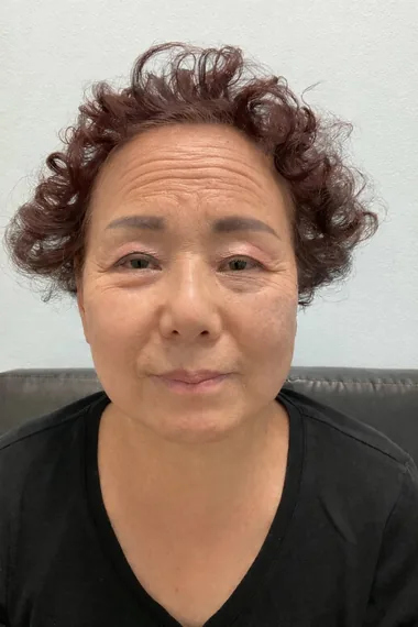 Forehead lines before Botox