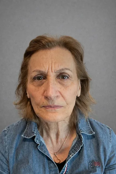 Frown lines before Botox