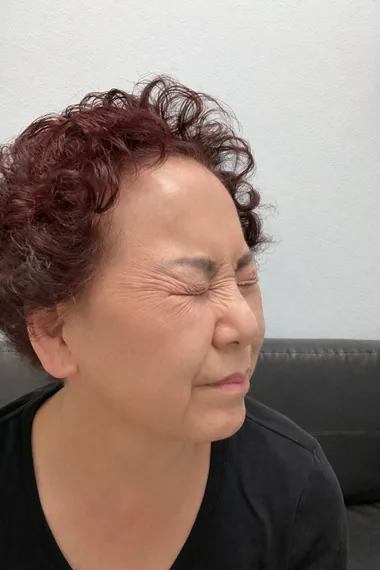 Crow's feet before Botox
