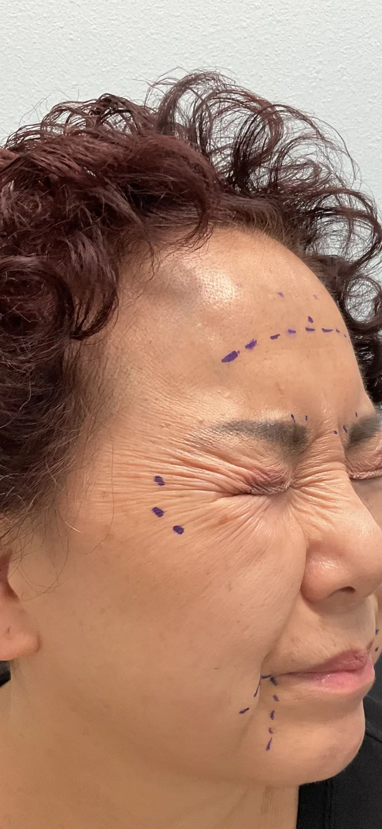 Crow's feet Botox treatment at Lily Med Spa