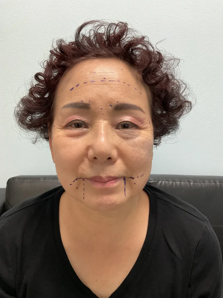 Pre-treatment facial marking by Dr. Choudhary
