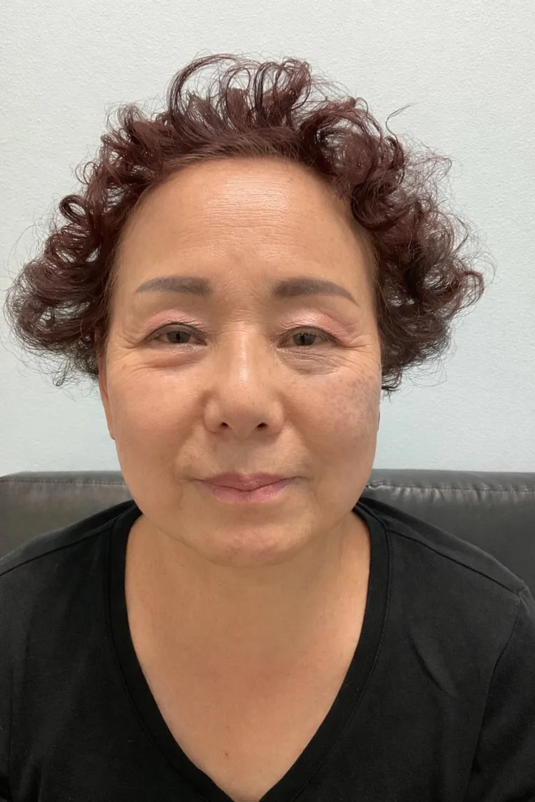 Patient after Botox treatment at Lily Med Spa