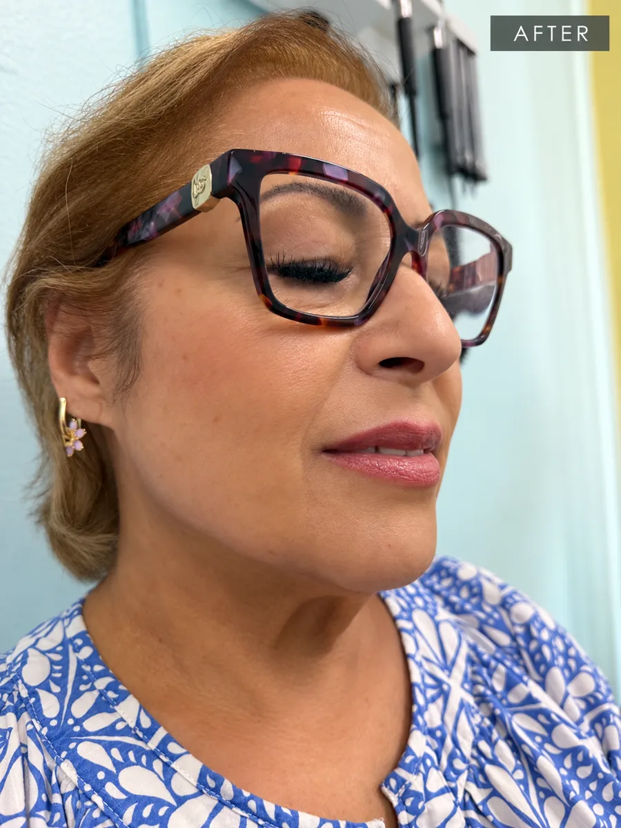 Patient after facial rejuvenation treatment at Lily Med Spa